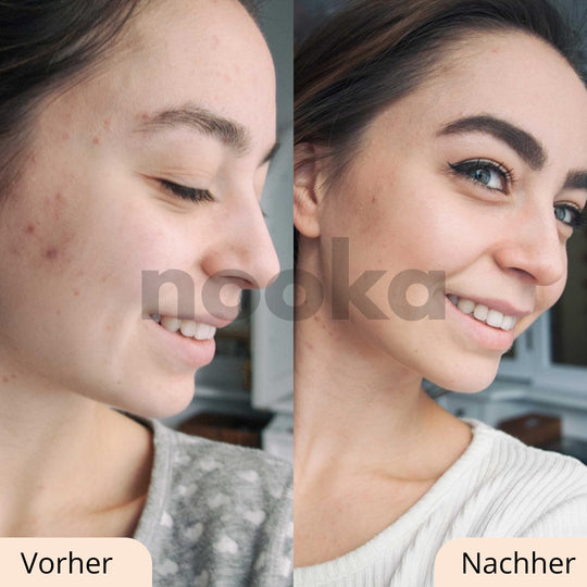GlowStripes™ für straffe, glatte und schöne Haut!