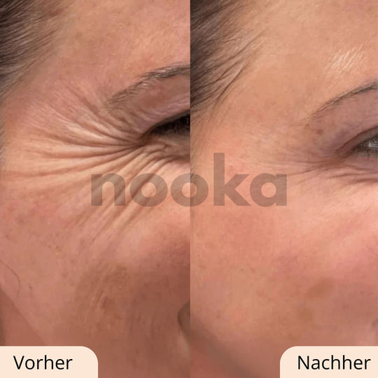 GlowStripes™ für straffe, glatte und schöne Haut!